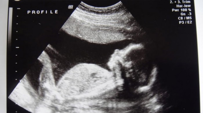 Sonography scan of foetus